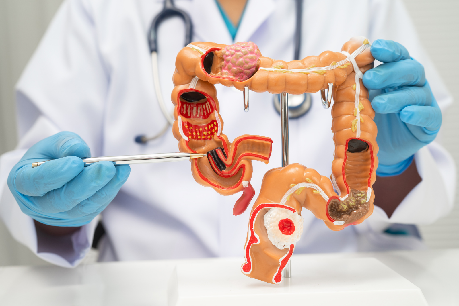 Colorectal Cancer Screening and Colonoscopy in Hyderabad