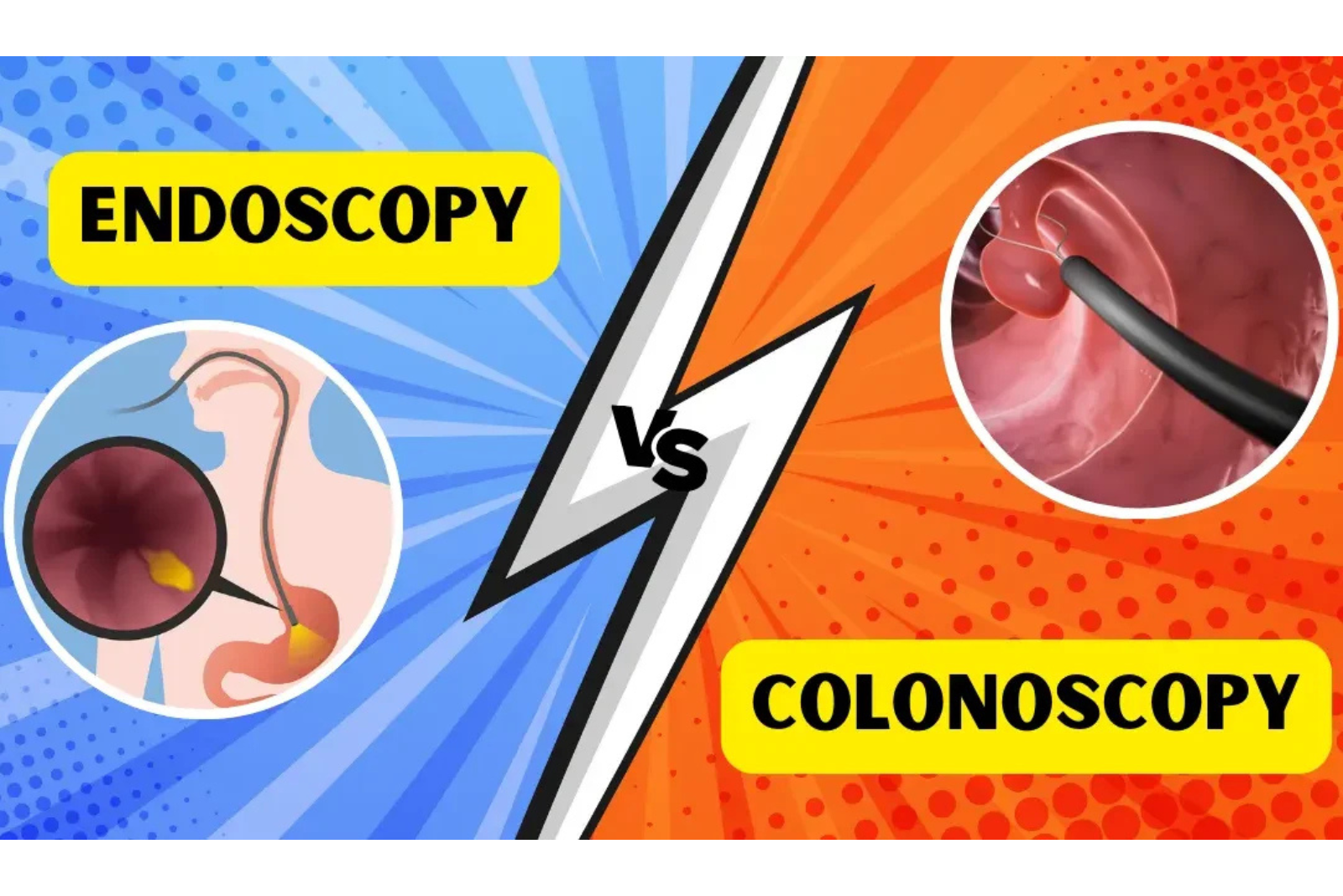 Endoscopy & Colonoscopy: What to Expect During the Procedure