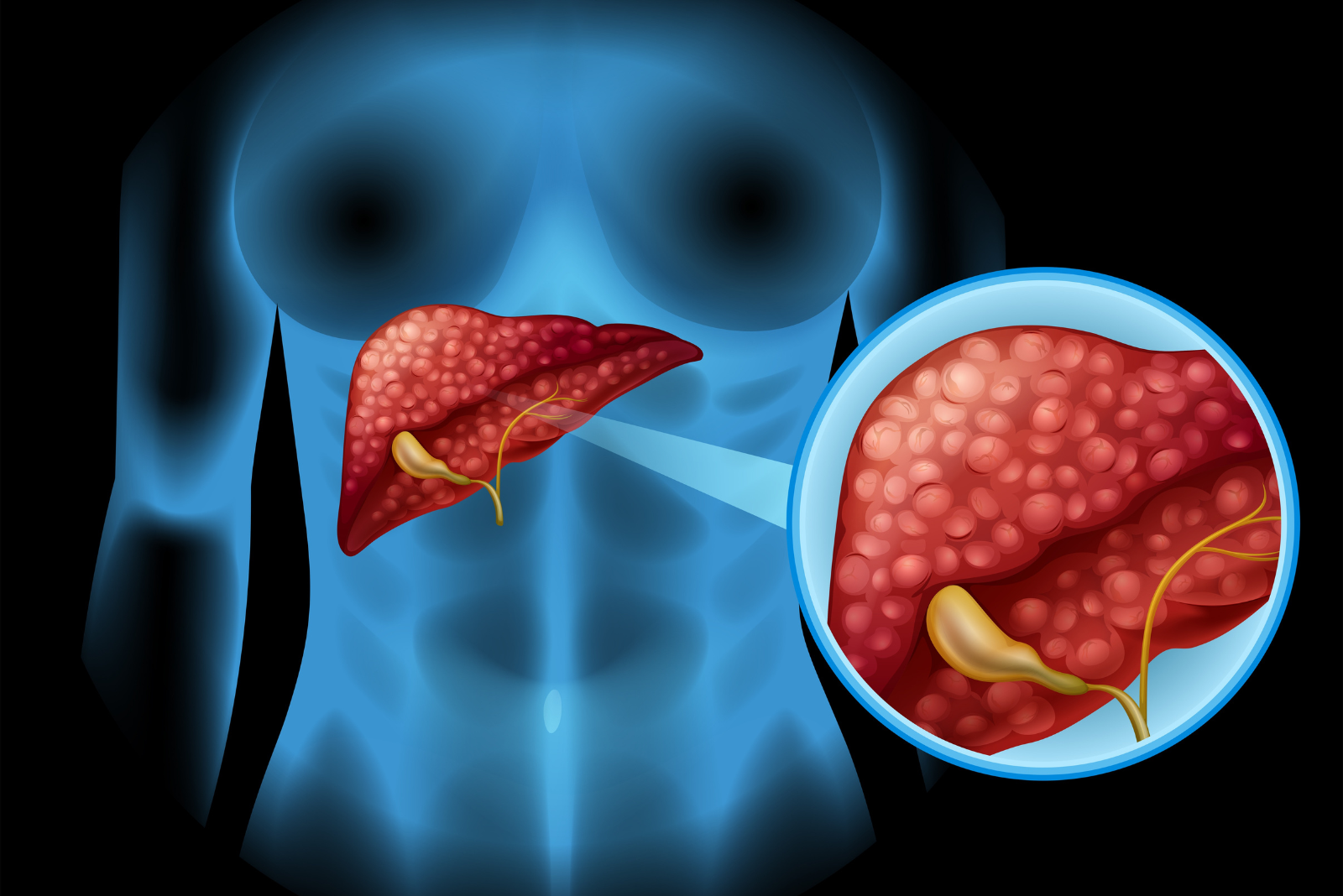 Fatty Liver Disease: Symptoms, Causes and Treatment