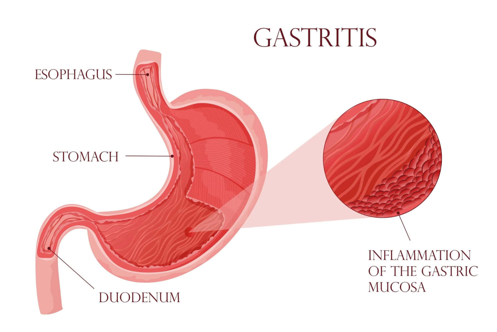 Gastritis: Causes, Signs and When to See a Specialist