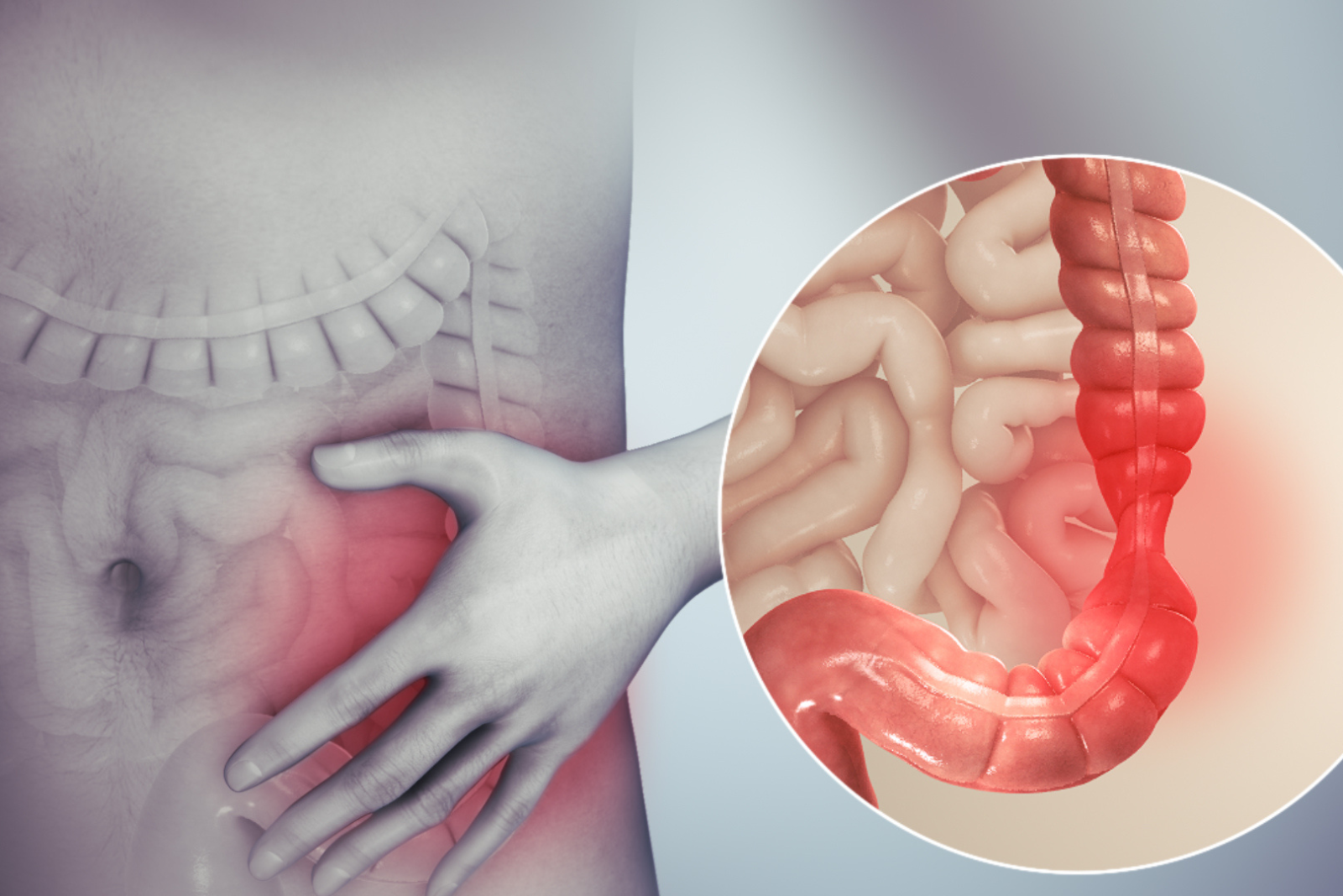 IBS — Irritable Bowel Syndrome: Expert Treatment in Hyderabad