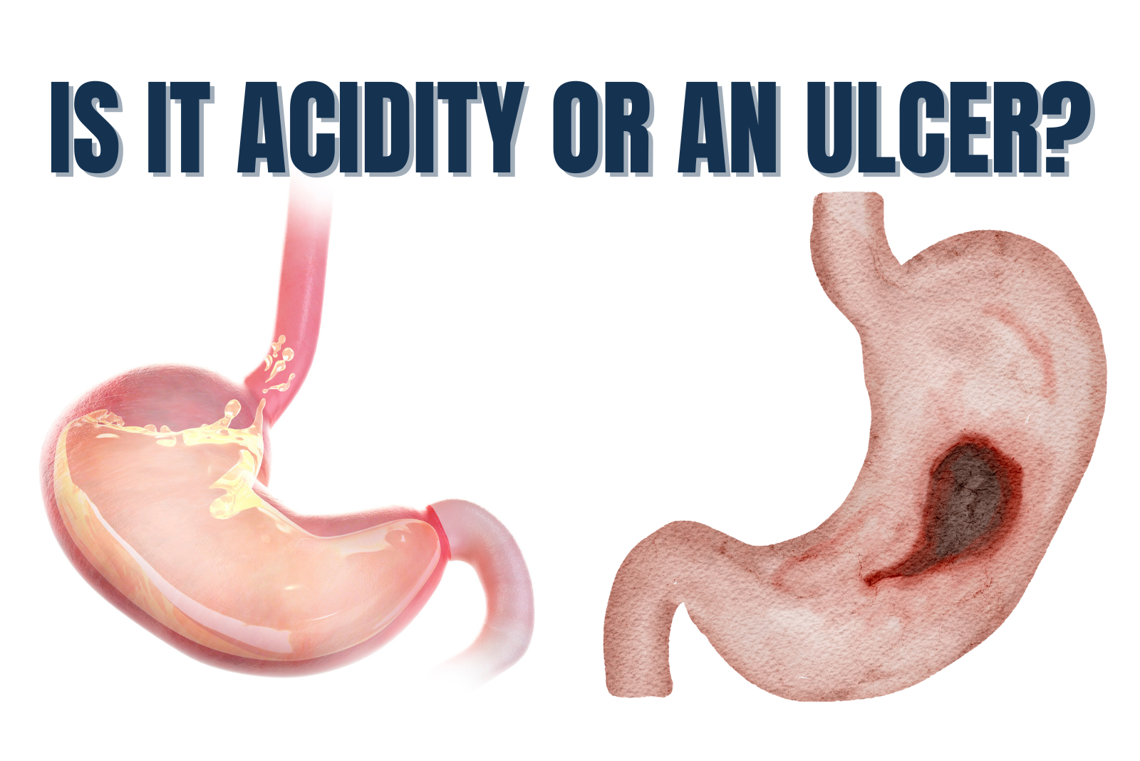 Is It Acidity or an Ulcer? How to Tell the Difference