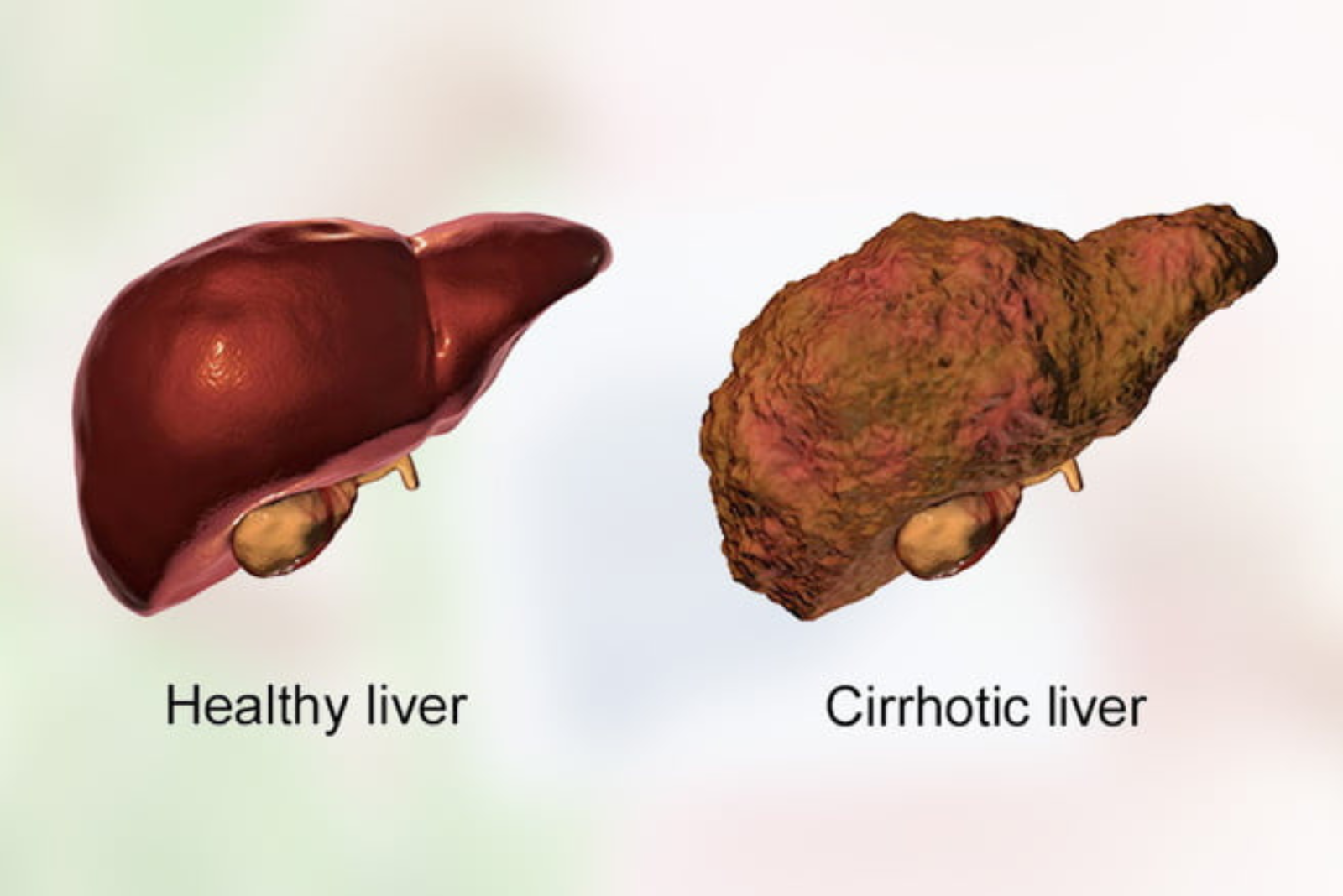 Liver Cirrhosis: Symptoms, Causes and Expert Treatment in Hyderabad