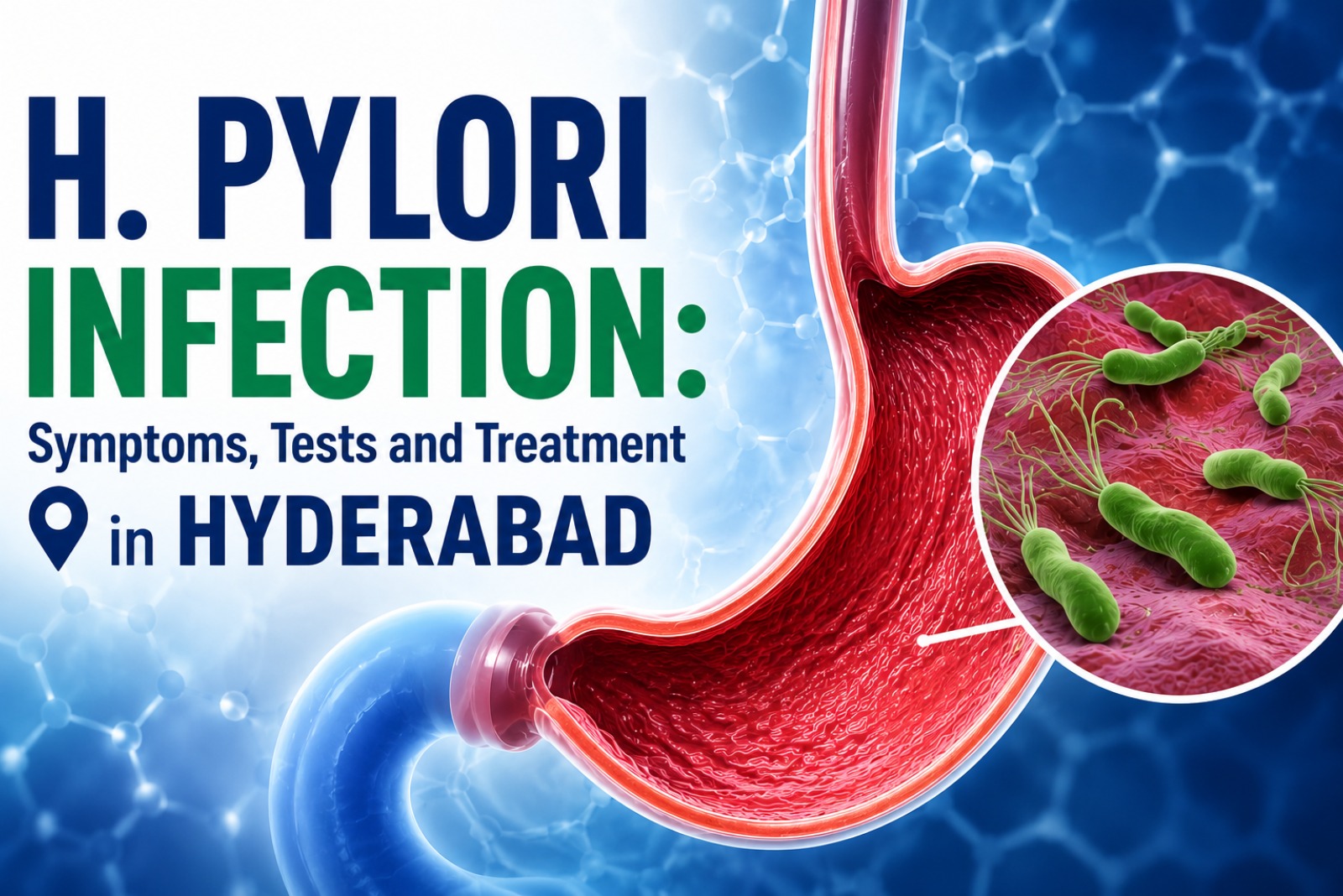 H. Pylori Infection: Symptoms, Tests and Treatment in Hyderabad