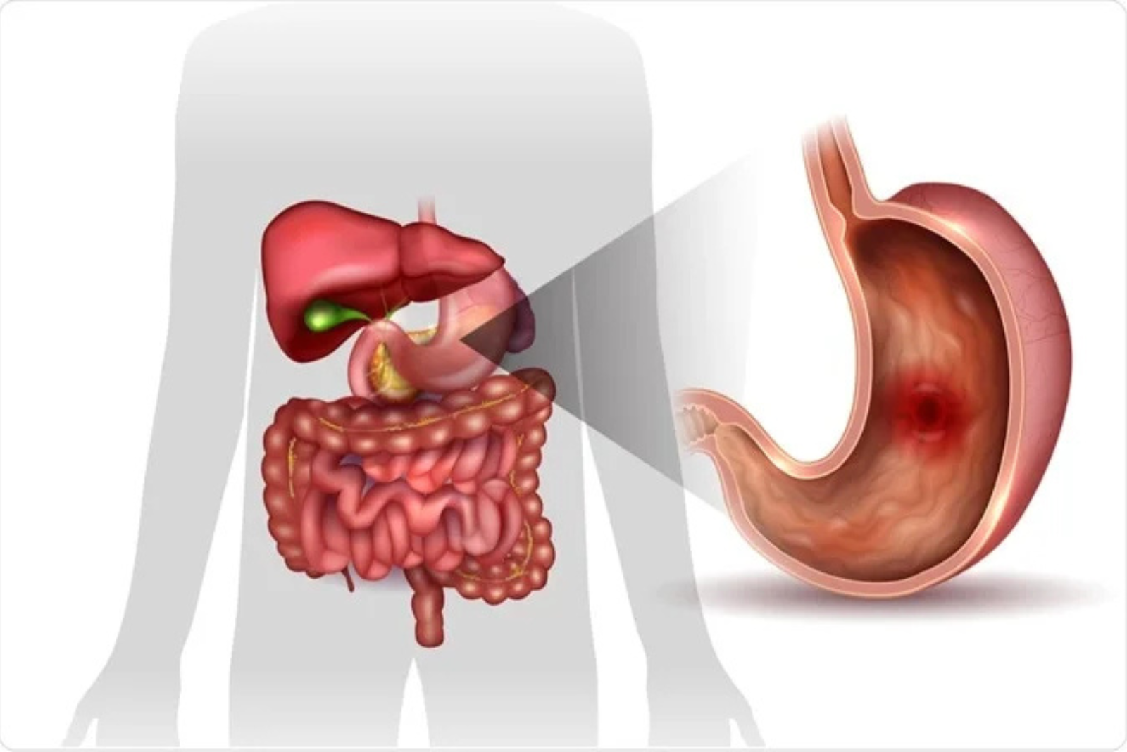 How Doctors Diagnose Stomach Ulcers