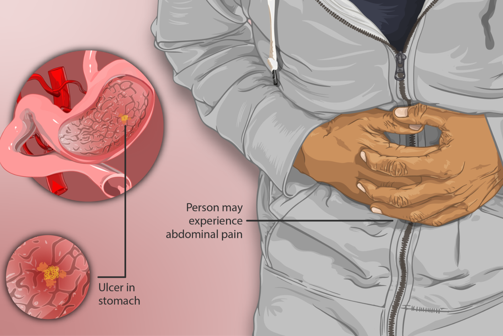 Ulcer Pain: Where It Occurs and How It Feels