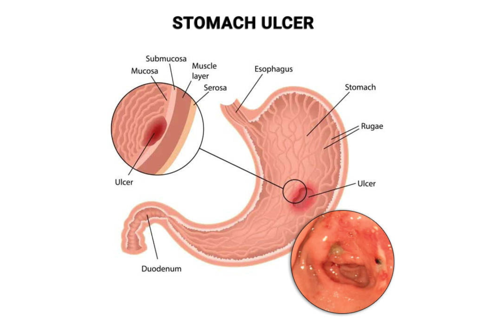 What Causes Stomach Ulcers? 8 Common Triggers