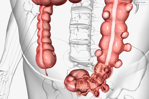 What Is Diverticulosis vs. Diverticulitis?